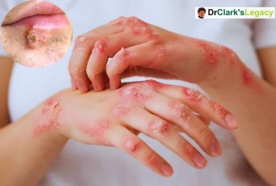 Herpes