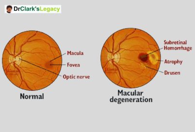 Macular Degeneration