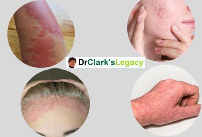 Skin Disease