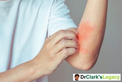 Skin Rash