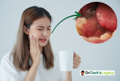 Tooth Decay
